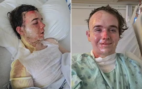 Funcionário de rede de Fast Food sofre queimaduras após ser atingido por óleo fervente em ataque de colega