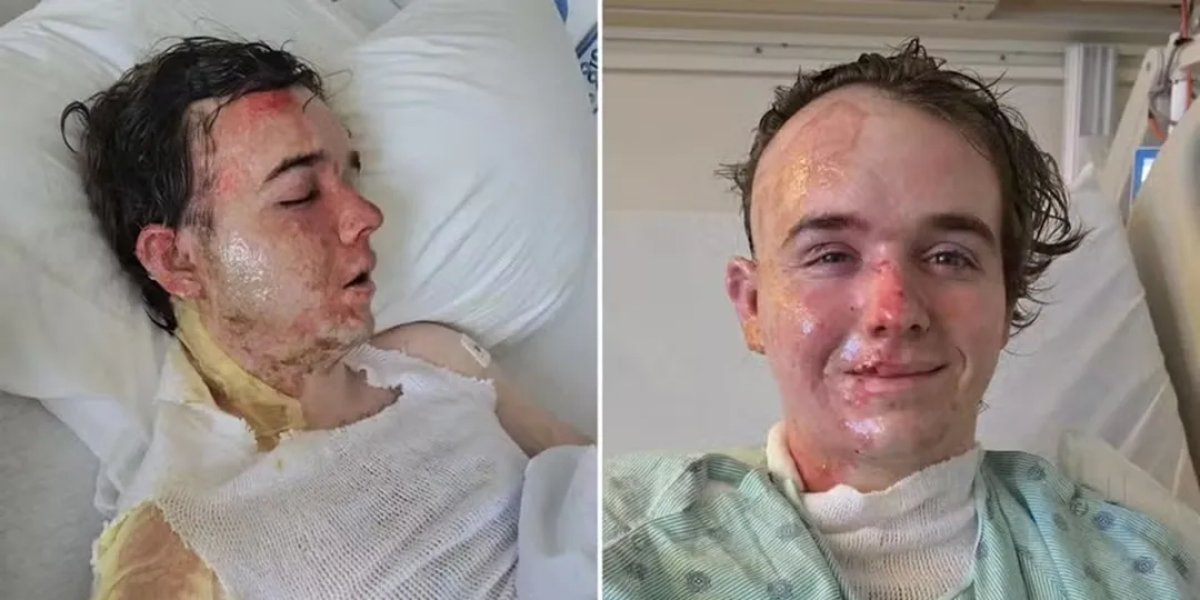 Funcionário de rede de Fast Food sofre queimaduras após ser atingido por óleo fervente em ataque de colega