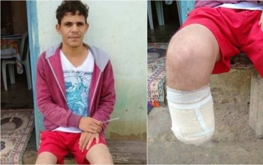 Pé amputado por servidor para fraudar seguro foi encontrado dentro de mochila