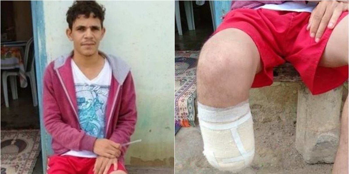 Pé amputado por servidor para fraudar seguro foi encontrado dentro de mochila