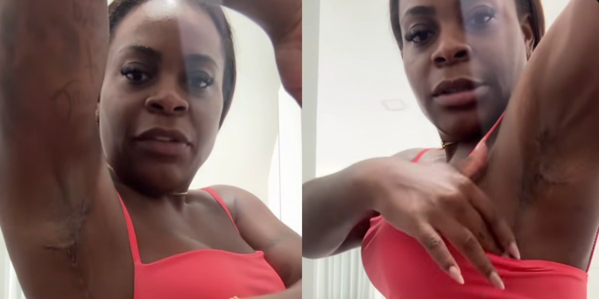 Jojo Todynho exibe cicatrizes após nova cirurgia reparadora
