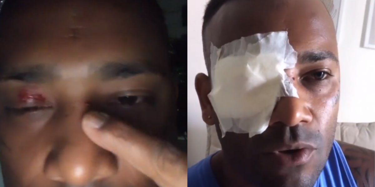 Cantor Mário Brasil sofre acidente e quase fica cego