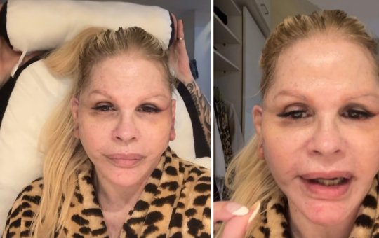Monique Evans relata perrengue com banco após cirurgia facial: “Não me reconheceram”
