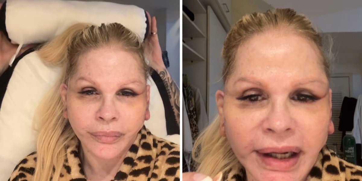Monique Evans relata perrengue com banco após cirurgia facial: “Não me reconheceram”