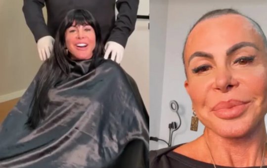 Gretchen raspa a cabeça em live antes de transplante capilar
