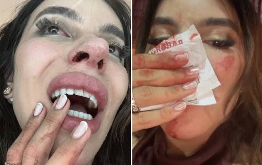 Influenciadora Léa Reis aparece machucada e denuncia agressão motivada por transfobia