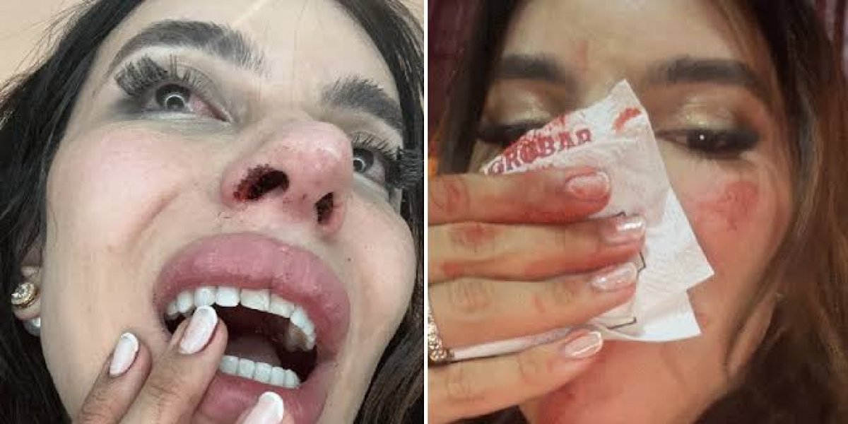Influenciadora Léa Reis aparece machucada e denuncia agressão motivada por transfobia