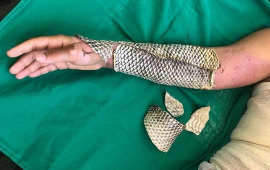 Brasil transforma pele de tilápia em curativo para queimaduras e prepara produção em larga escala