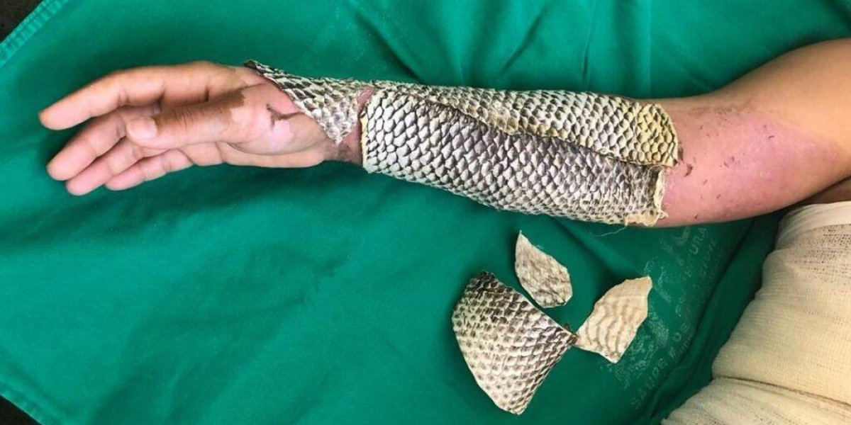 Brasil transforma pele de tilápia em curativo para queimaduras e prepara produção em larga escala