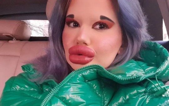 Mulher com os maiores lábios do mundo diz que quer se parecer com boneca Bratz