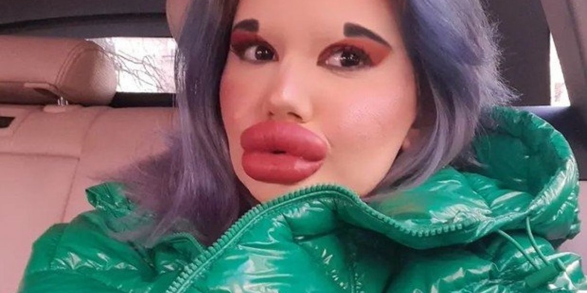 Mulher com os maiores lábios do mundo diz que quer se parecer com boneca Bratz